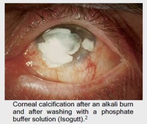 PREVOR: corneal calcification