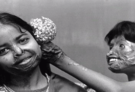 Kinder Säure Verätzungen Bangladesch