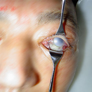 Lesiones químicas en los ojos