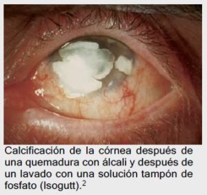 PREVOR: calcificación corneal